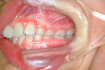 Abb. 5h: Intraorale Fotografien 9-jähriger Klasse-II-Patient (Frontalansicht, Overbite/Overjet, Lateralansicht rechts/links).