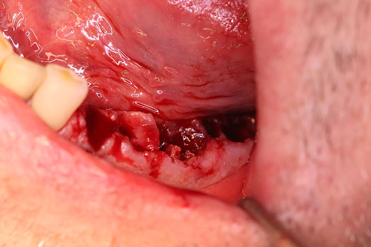 Abb. 6: Zahnentfernung durch Osteotomie.