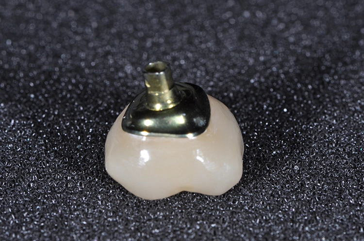 Abb. 6: EAP® Abutment mit Krone verklebt.