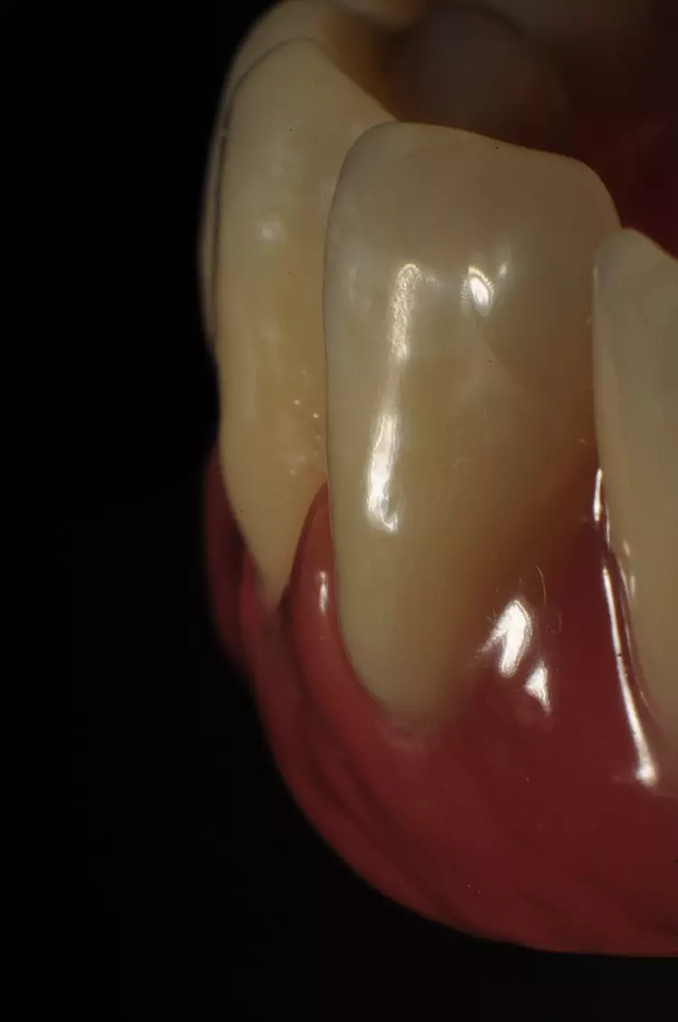 Abb. 6: Wunderschöner Gingivarand mit eleganten Radien, homogen und glatt – aber auch Lackspuren von nicht gleichmäßig aufgetragenem Prothesenlack.