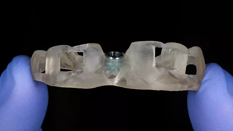 Abb. 6: 3D-gedruckte Führungsschablone für geführte Implantation.