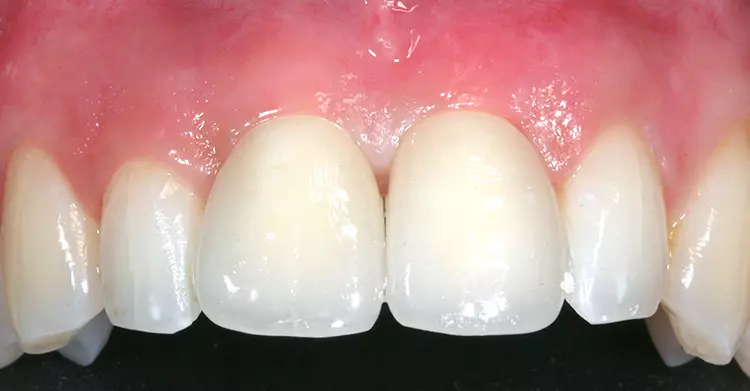 Abb. 6: Frontalansicht der Implantatkronen regio 11 und 21 mit augmentiertem Weichgewebe. Deutliche Verbesserung des Biotypus im Vergleich zur Ausgangssituation.
