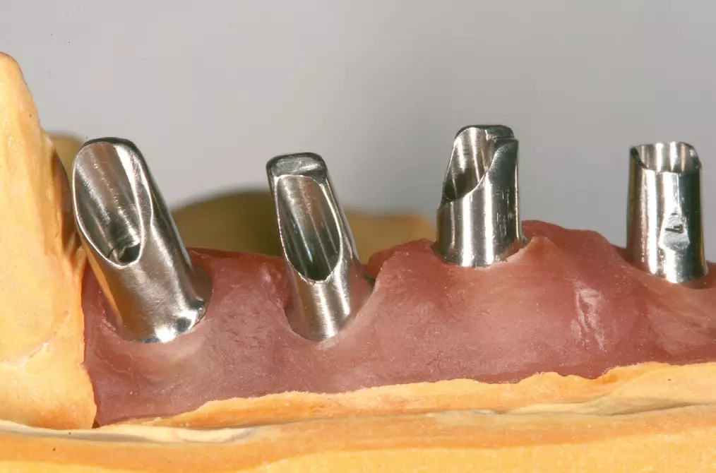 Abb. 6: Die individualisierten Aufbauten auf dem Modell. Die Angulationen der Implantate konnten ausgeglichen werden.