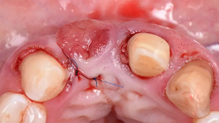 Abb. 6: Über den Tunnel eingebrachtes und mit Mikronähten fixiertes Tubertransplantat.