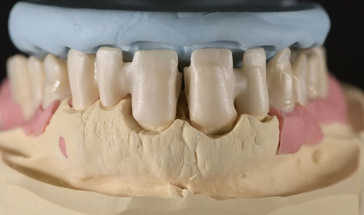 Abb. 6: Die nach palatinal versetzte Aufstellung. Ein Silikonschlüssel hilft uns dabei, dem erarbeiteten Wax-up treu zu bleiben und das angestrebte Erscheinungsbild zu erreichen.