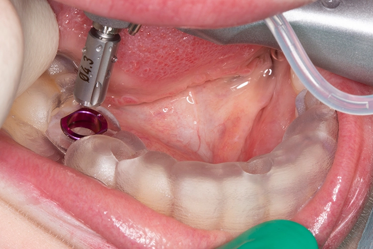 Abb. 6: Die Implantatchirurgie wurde mit einer 3D-gedruckten Bohrschablone durchgeführt.