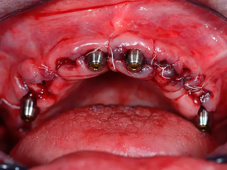 Abb. 6: Einheilkappen in situ im Oberkiefer des Patienten.