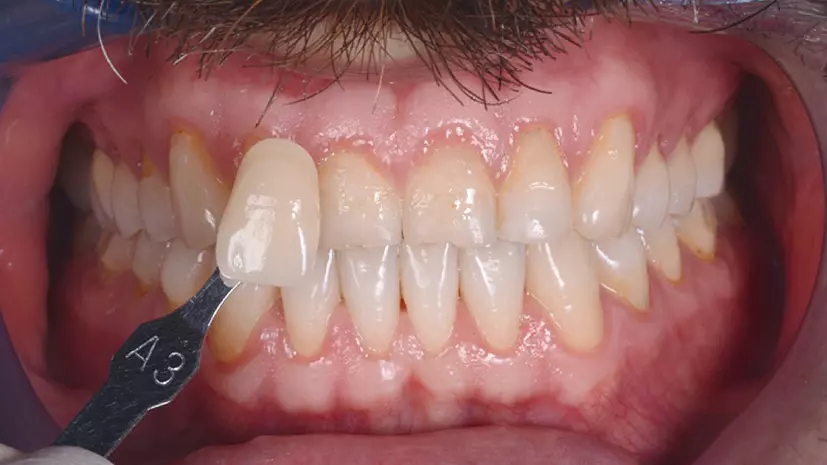 Abb. 6: Behandlungsphase 1 von 2: Situation vor dem Bleaching der Zähne.