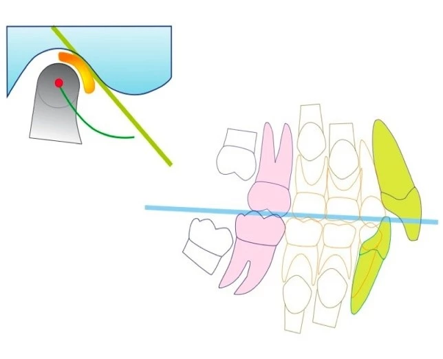 Abb. 6a: Schematische Darstellung der Ausgangssituation (links) und der therapeutischen „Zielposition“ mittels FPOs (rechts) inkl. Vertikalerhöhung und anteriorer Adaptation des Unterkiefers.