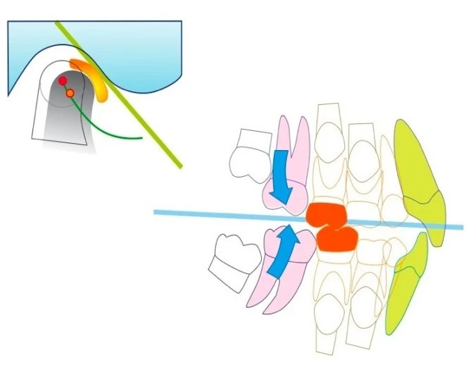 Abb. 6b: Schematische Darstellung der Ausgangssituation (links) und der therapeutischen „Zielposition“ mittels FPOs (rechts) inkl. Vertikalerhöhung und anteriorer Adaptation des Unterkiefers.