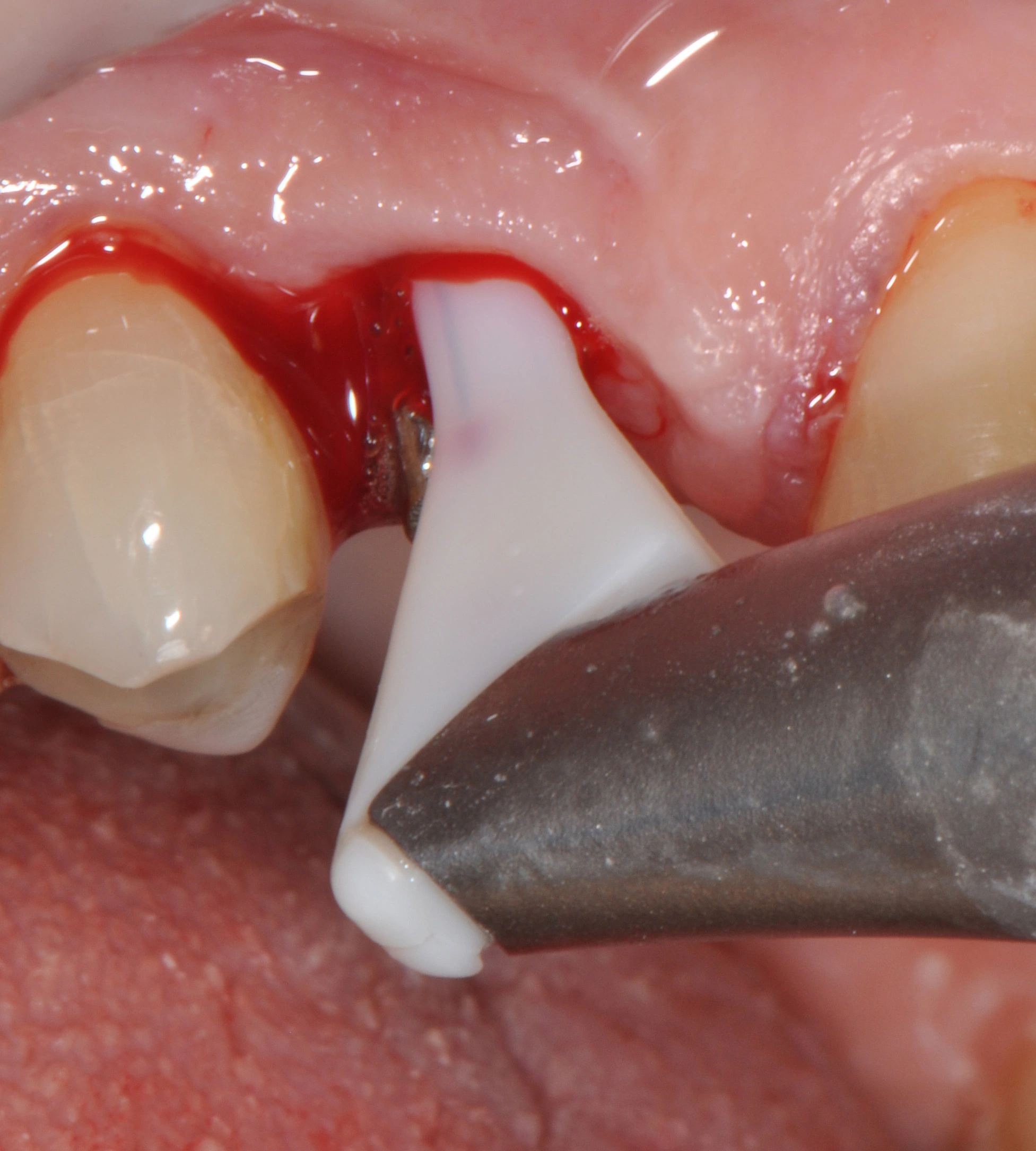 Abb. 7: Taschendekontamination mit Erythritolpulver, appliziert mittels subgingivaler Spitze.