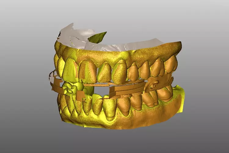 Abb. 7: Digitalisierte Patientensituation mittels Intraoralscan.