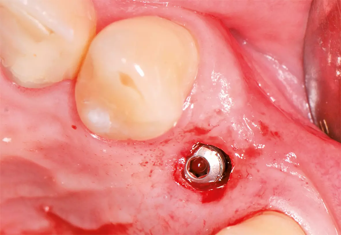 Abb. 7: Implantatinsertion in regio 24 drei Monate nach der Zahnextraktion.