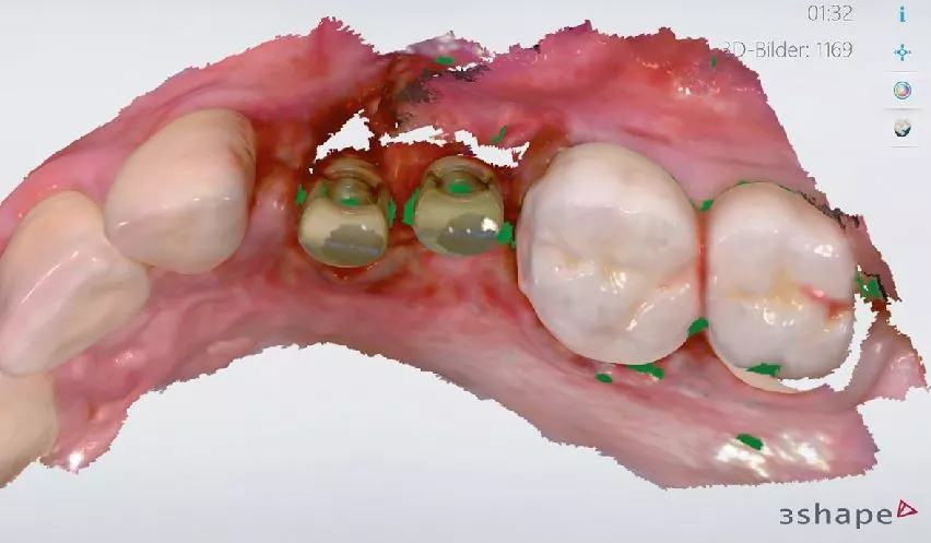 Abb. 7: Intraoperativer Intraoralscan für die provisorische Versorgung.