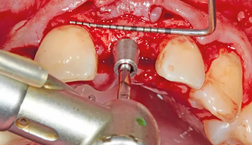 Abb. 7: Implantation.