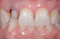Abb. 2a: Nach Fraktur des endodontisch vorbehandelten Zahns wird für eine monolithische Vollkeramikkrone präpariert.