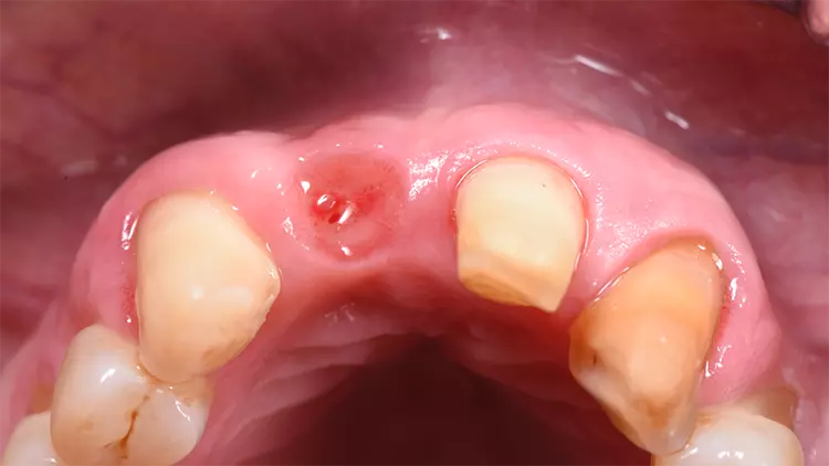 Abb. 7: Deutliche Volumenzunahme in regio 11 nach einer Einheilzeit von 3 Monaten sowie ponticartige Ausformung durch die provisorische Versorgung.