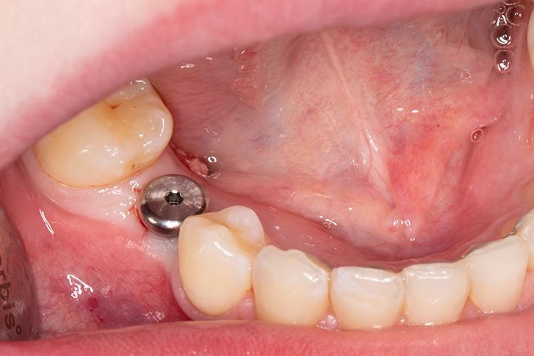 Abb. 7: Das Gingiva-Abutment wurde nach dem Eingriff am Implantat befestigt.