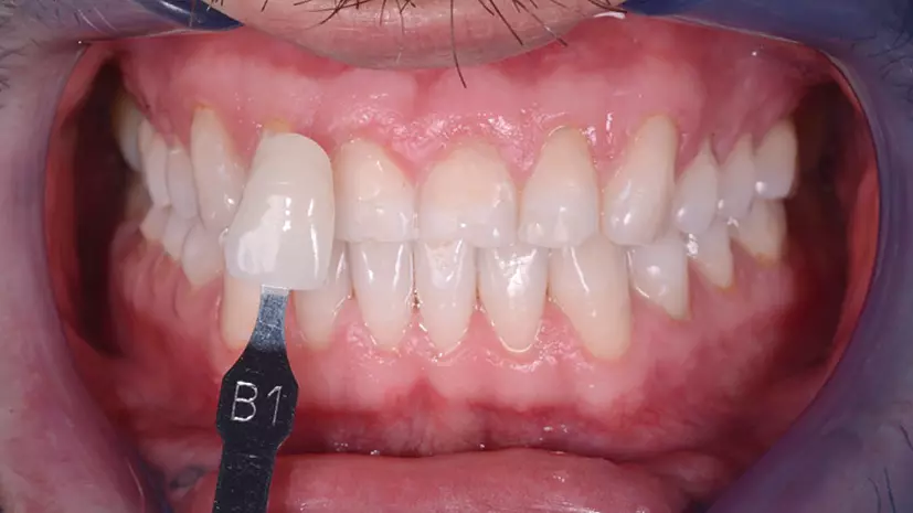 Abb. 7: Behandlungsphase 1 von 2: Situation nach dem Bleaching.