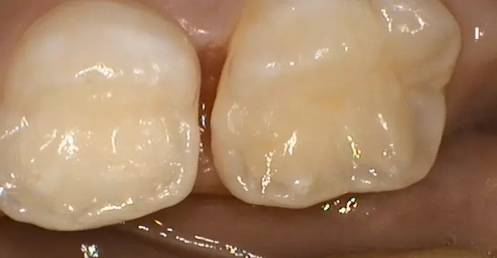 Abb. 7: Entfernung des Separiergummis nach 2 Tagen, Diagnostik mittels Lupe.