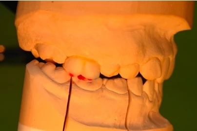 Abb. 7a: Wax-up der Ober-/Unterkiefer-2.-Milchmolaren i.S. einer Odontoplastik – seitliche Ansicht; Erhöhung der vertikalen Dimension, Disokklusion der 6-Jahr-Molaren, anteriore Adaptation des Unterkiefers und verbesserter Overbite/Overjet.