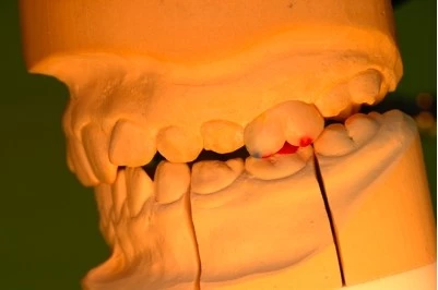 Abb. 7b: Wax-up der Ober-/Unterkiefer-2.-Milchmolaren i.S. einer Odontoplastik – seitliche Ansicht; Erhöhung der vertikalen Dimension, Disokklusion der 6-Jahr-Molaren, anteriore Adaptation des Unterkiefers und verbesserter Overbite/Overjet.