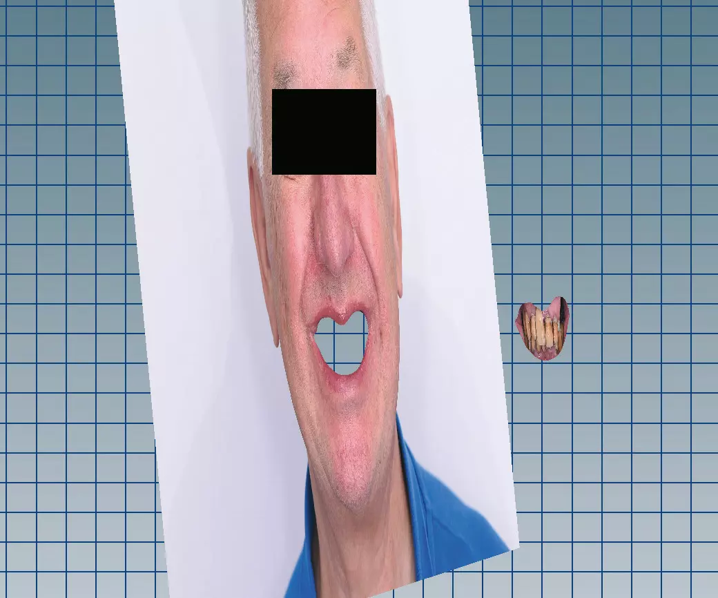 Abb. 7b: Ausschneiden der Zähne und des Zahnfleisches aus dem Lachbild.