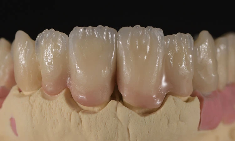 Abb. 7c: Erster Dentinbrand.