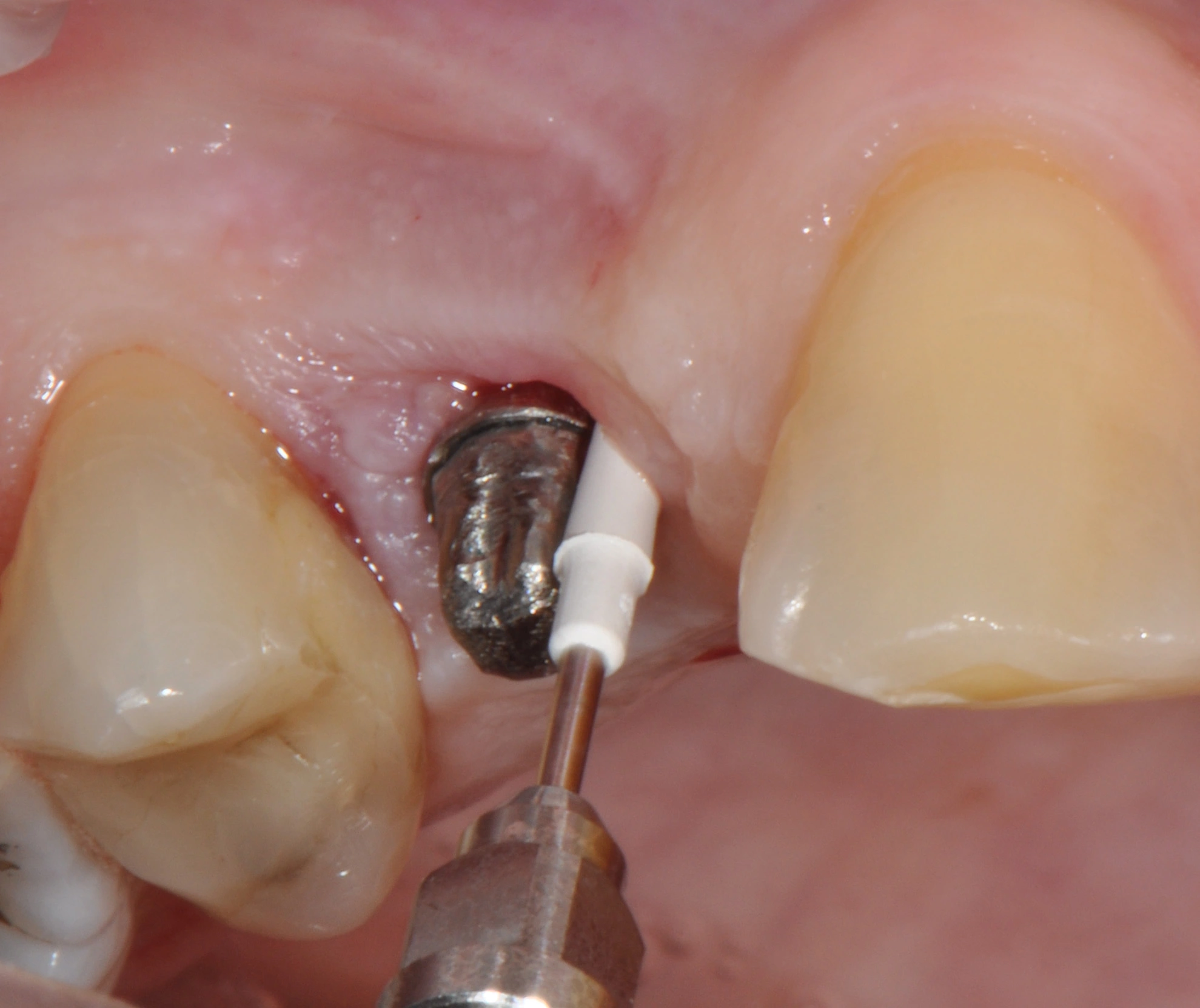 Abb. 8: Débridement der Implantatoberfläche mit piezoelektrischem Gerät und PEEK-Spitze.