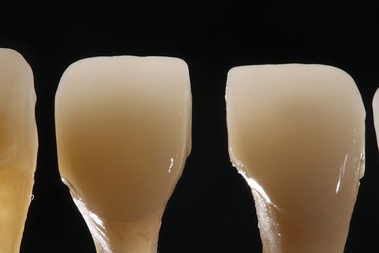 Abb. 8: Die endgültigen bemalten und glasierten Restaurationen wiesen eine
natürliche Transluzenz und einen nahtlosen Übergang von Dentin zu Schmelz auf.