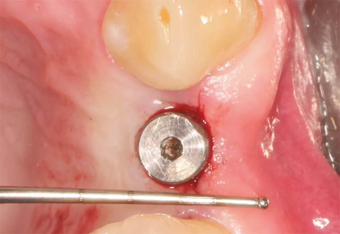 Abb. 8: Freilegung des Implantates in regio 24 drei Monate nach der Implantation.