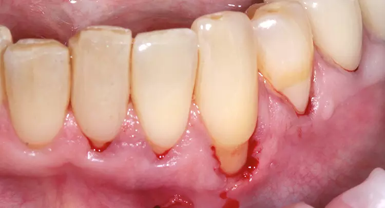 Abb. 8: Inzision lateral der zu operierenden Rezession und erfolgte subperiostale Präparation mithilfe der GumLift© Instrumente nach Padilla/Wainwright.