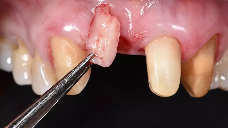 Abb. 8: Bindegewebstransplantat vom Gaumen.