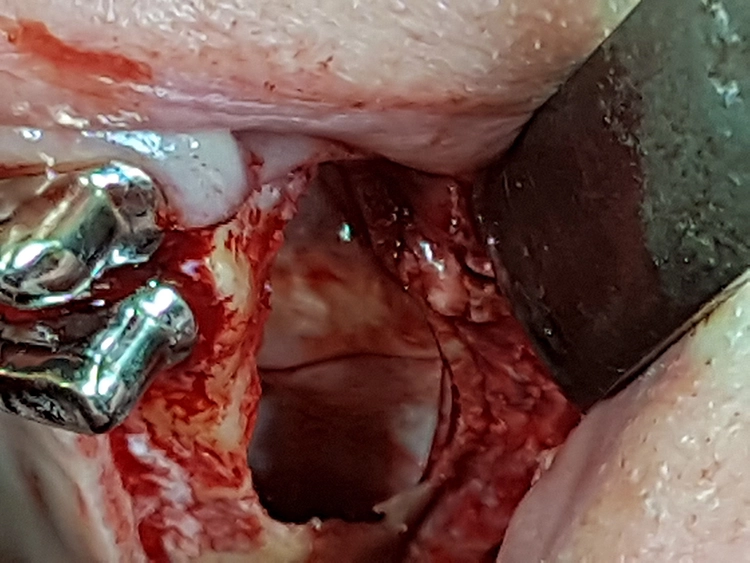 Abb. 8: Abdichtung der MAV zur Kieferhöhle mit der porcinen Kollagenmembran Mem-Lok Pliable.
