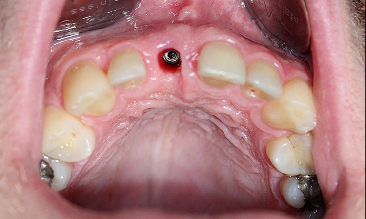 Abb. 8: Die gingivale Situation vor dem Einsetzen des Abutments im Jahr 2011.
