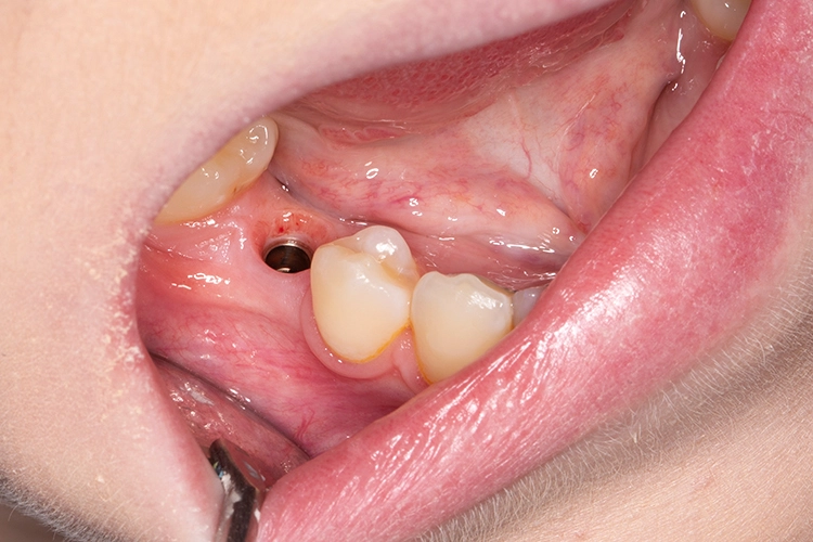 Abb. 8: Das Scan-Abutment wurde für die Restaurationsplanung auf dem Implantat platziert.