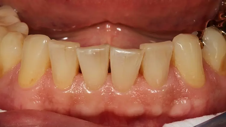 Abb. 8: Klinische Situation bei einer Nachkontrolle nach 6 Monaten (Ansicht von labial).