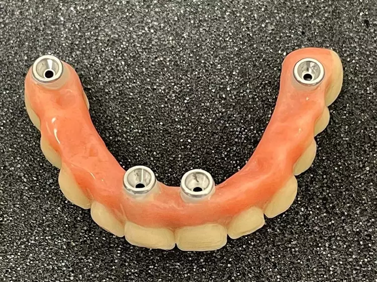 Abb. 7: Provisorische Brücke für die Sofortversorgung.