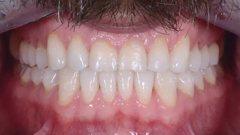 Abb. 8: Behandlungsphase 1 von 2: nach Abschluss mit Invisalign®.
