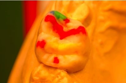 Abb. 8a: Wax-up der Ober-/Unterkiefer-2.-Milchmolaren i.S. einer Odontoplastik – okkusale Ansicht – veränderte Stampfhöckerrelation und -konfiguration (rot); protrusive/retrusive Kontrolle des Unterkiefers durch Herstellung einer Christa transversa (gelb) und Kontrolle der Laterotrusion durch die mesialen Randleisten (grün).