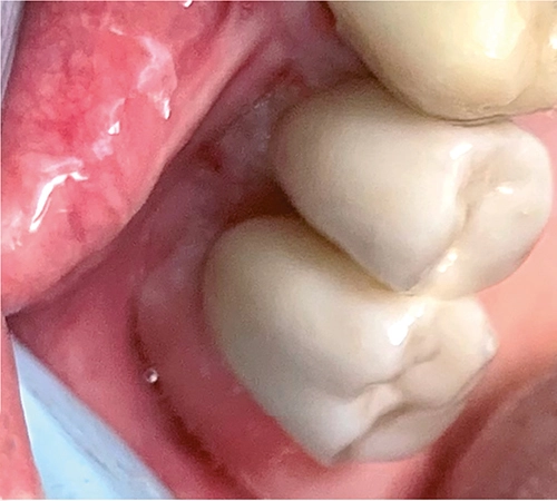 Abb. 8c: Friktionsfi xierte Rekonstruktion.