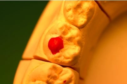 Abb. 8c: Wax-up der Ober-/Unterkiefer-2.-Milchmolaren i.S. einer Odontoplastik – okkusale Ansicht – veränderte Stampfhöckerrelation und -konfiguration (rot); protrusive/retrusive Kontrolle des Unterkiefers durch Herstellung einer Christa transversa (gelb) und Kontrolle der Laterotrusion durch die mesialen Randleisten (grün).