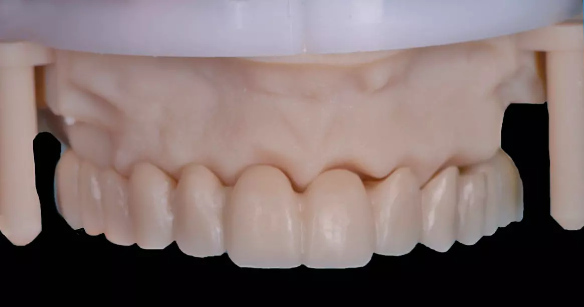 Abb. 8g: Gefrästes PMMA-Provisorium in der Ansicht frontal.