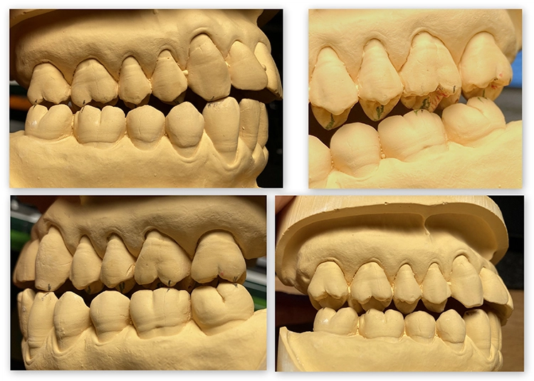 Abb. 9: Die Mediotrusion nach rechts zeigt deutliche Spuren am mesiopalatinalen Höcker des oberen ersten Molaren (26), die Mediotrusion nach links zeigt ebenfalls Balancekontakte an 16, wenn auch etwas schwächer ausgeprägt.