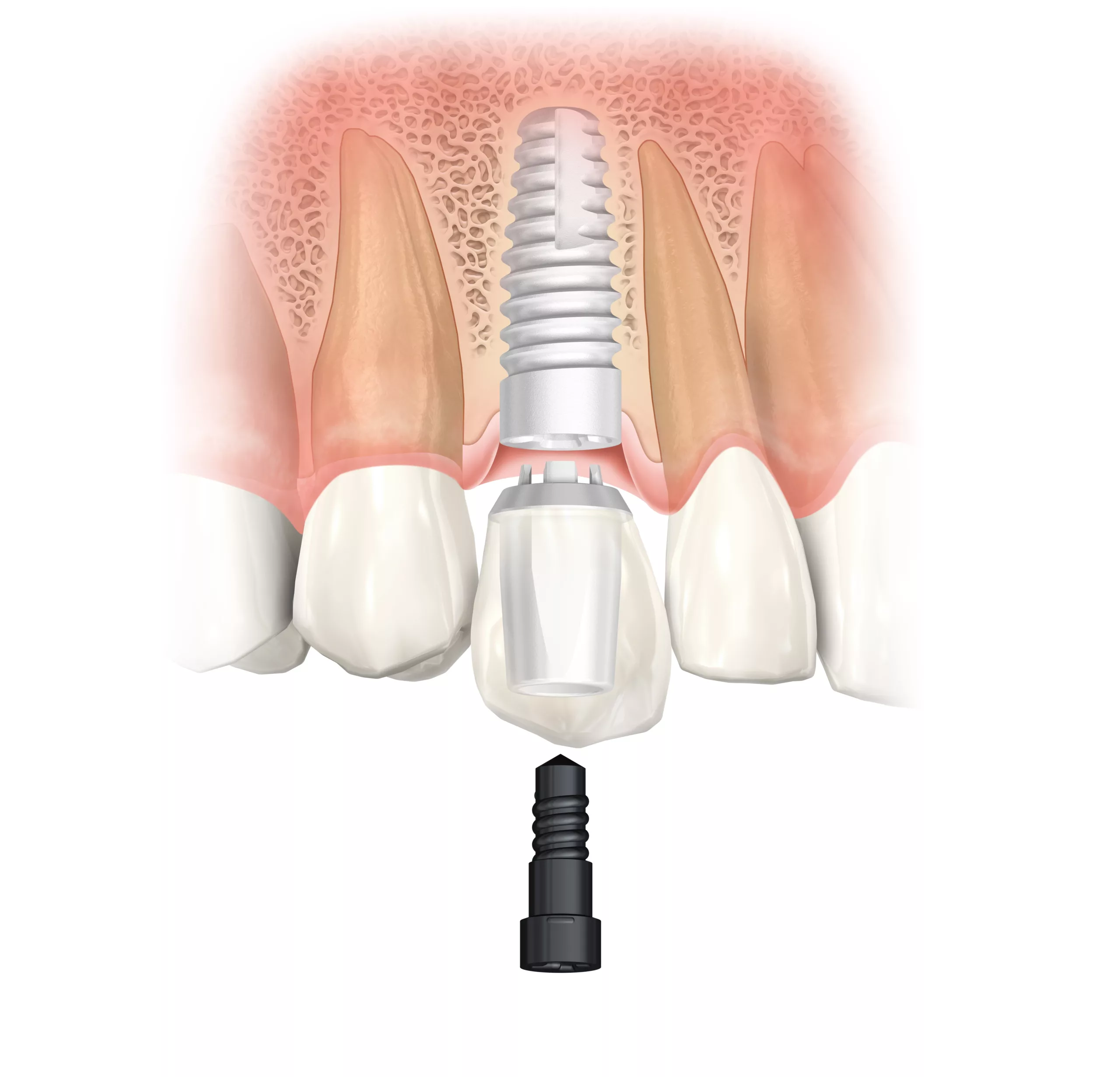 Das Keramikimplantat NobelPearl.