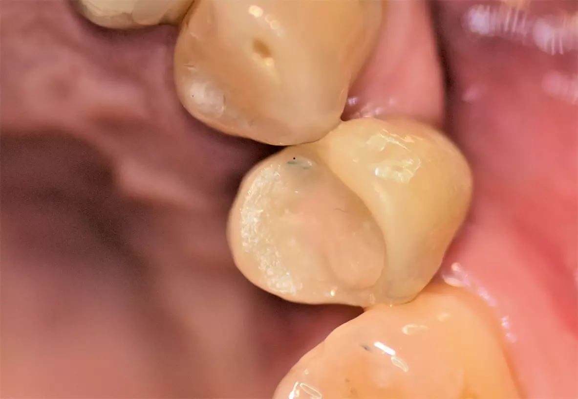 Abb. 9: Prothetische Versorgung des Implantates in regio 24.