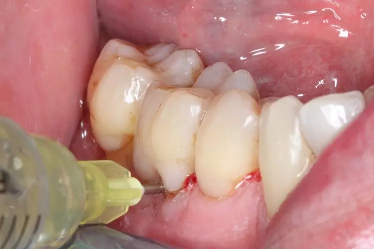 Abb. 9: Nach der Instrumentierung wurden die
Zahnflächen fluoridiert. Besonderes Augenmerk
wurde hierbei auf die kritischen Areale im Furkationsbereich gelegt. Das Fluoridgel wurde hier mit
einer Spritze und einer stumpfen Kanüle appliziert.