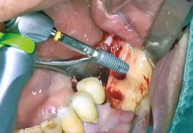 Abb. 9: Das Implantat (Astra Tech EV Profile) mit der abgeschrägten Implantatschulter.