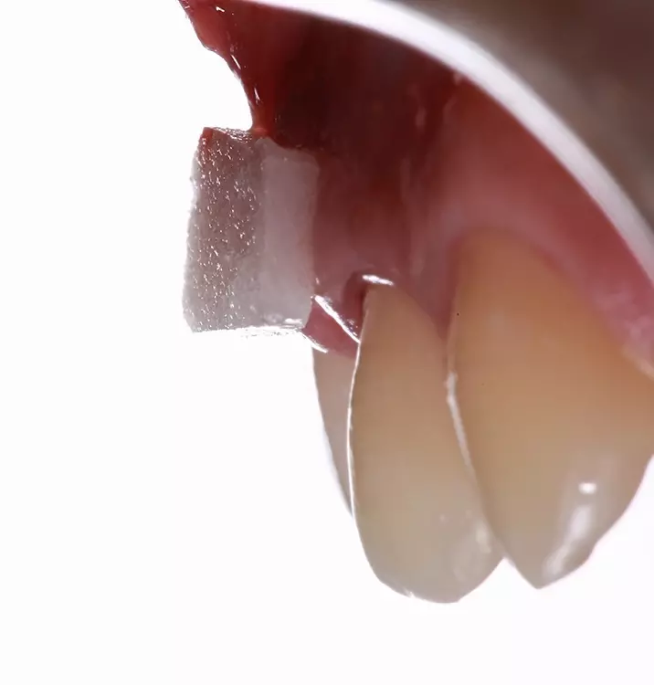 Abb. 9: Um das vestibuläre Gingivavolumen zu
vergrößern, wird eine Kollagenmatrix aus porciner
Dermis eingesetzt.