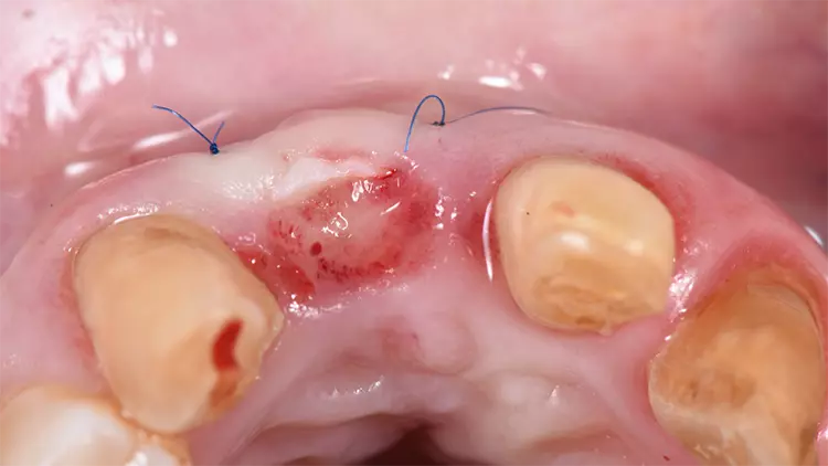 Abb. 9: Fixierung des Transplantats in der präparierten Tasche.